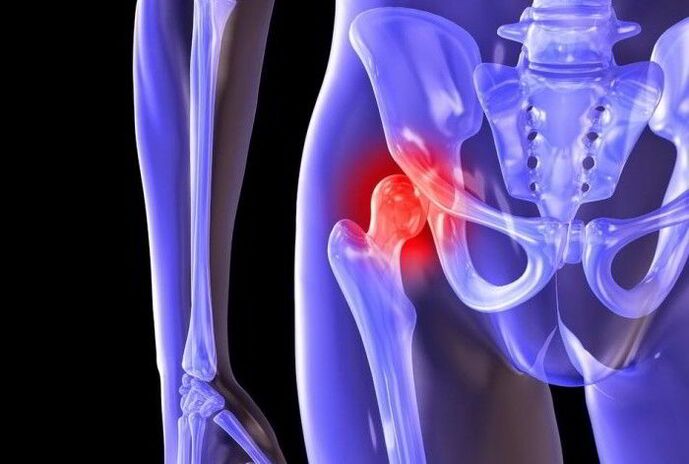 Proceso patolóxico na articulación da cadeira con coxartrose